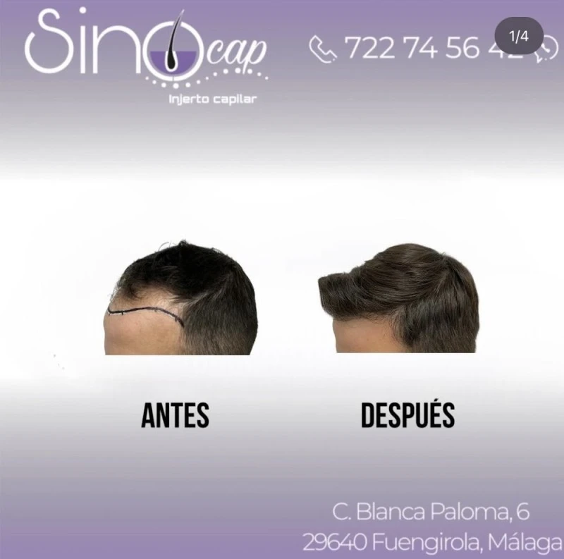 Sinocap - Injerto Capilar