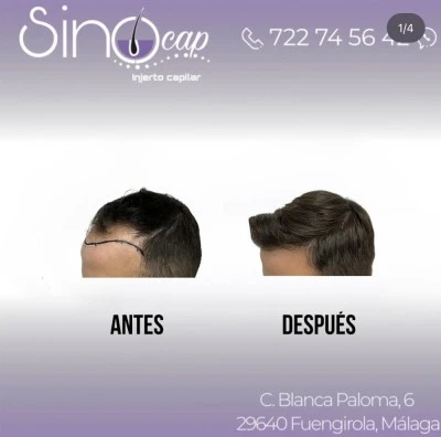 Sinocap - Injerto Capilar
